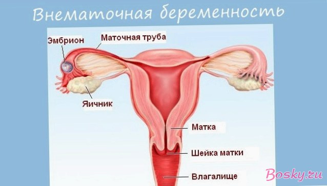 Замершая беременность: обстоятельства страшной патологии